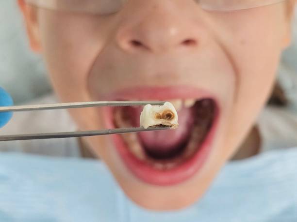 Best Dentist for Tooth Abscess  in East Porterville, CA